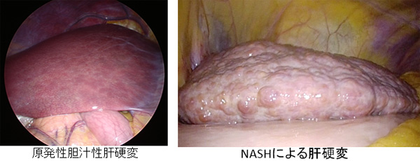 原発性胆汁性肝硬変　NASHによる肝硬変